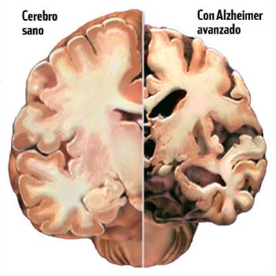 O que é A doença de Alzheimer