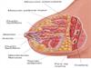 Abscesso de mama, Sintomas e Tratamento