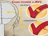 Acidente vascular cerebral - Sintomas e tratamento