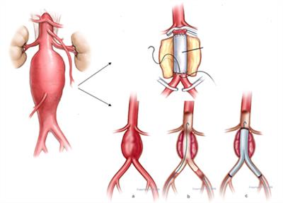 O que é Aneurisma da aorta abdominal