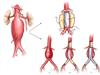 O que é Aneurisma da aorta abdominal