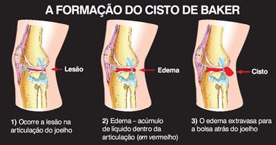 O que é Cisto de Baker