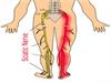 O que é ciática, sintomas e tratamento