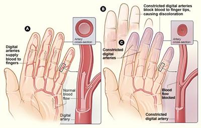 Fenômeno de Raynaud - dedos brancos e dos pés, sem fluxo de sangue