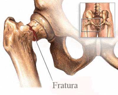 Fratura de quadril, o tratamento é necessário