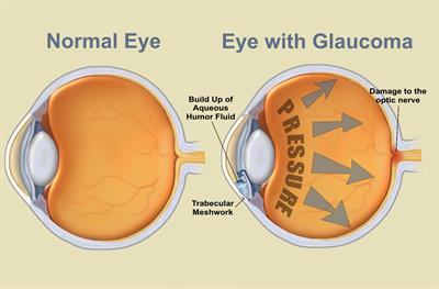 O que é Glaucoma