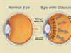 O que é Glaucoma