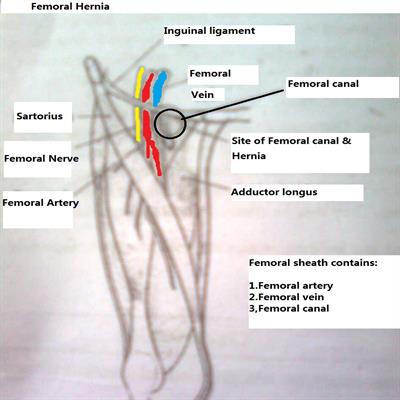 Hérnia femoral