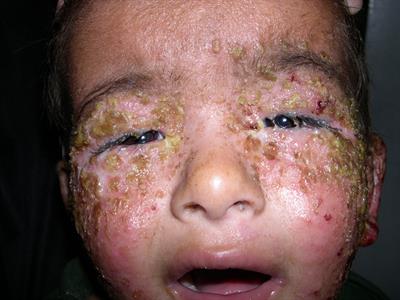 Impetigo