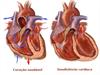 Insuficiência cardíaca