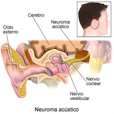 O que é o neurinoma do acústica