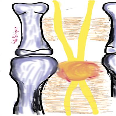 Neuroma de Morton - Sintomas e tratamento