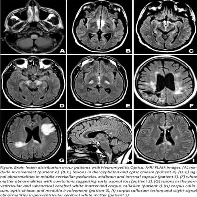 O que é Neuromielite Óptica