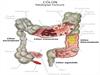 O que é Síndrome do intestino irritável (ibs)