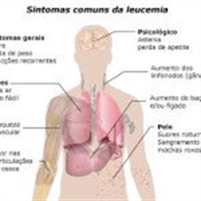 Síndrome mielodisplásica (mielodisplasia) - Anemia grave, sintomas e tratamento