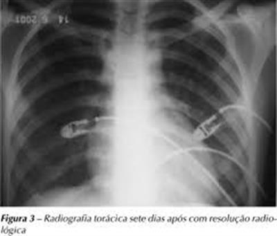 O que é Síndrome respiratória aguda